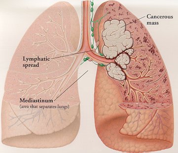 Bristol plans big lung cancer study, pairing immunotherapies