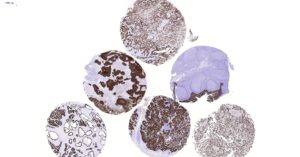 CKpan [BS5] stained multi tissue section of carcinoma/normal tissues with immunoperoxidase method